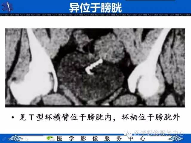 【病例】肝区异位节育器1例CT