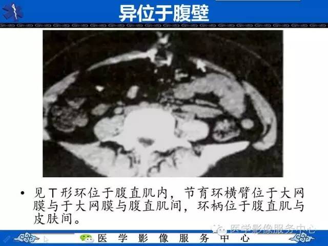 【病例】肝区异位节育器1例CT