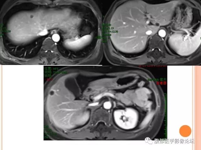 【病例】肝脏孤立性坏死结节ＳＮＮ一例MR