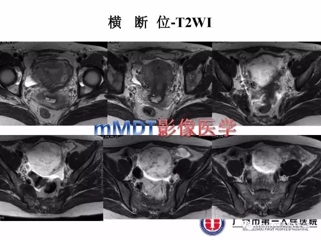 【病例】卵巢硬化性间质瘤1例MR