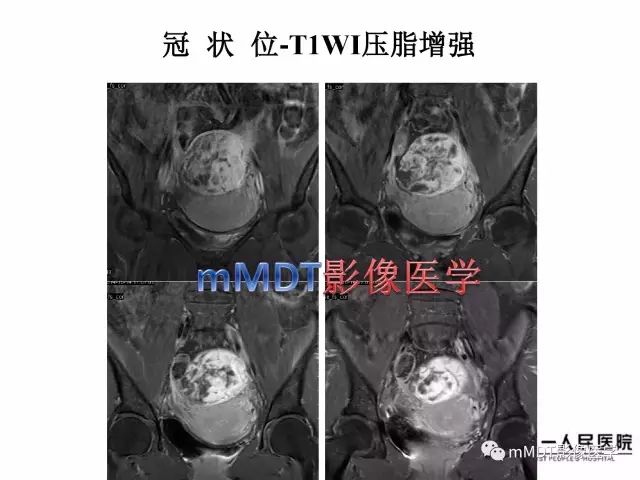 【病例】卵巢硬化性间质瘤1例MR