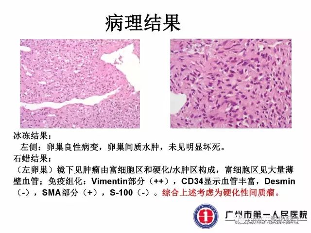 【病例】卵巢硬化性间质瘤1例MR