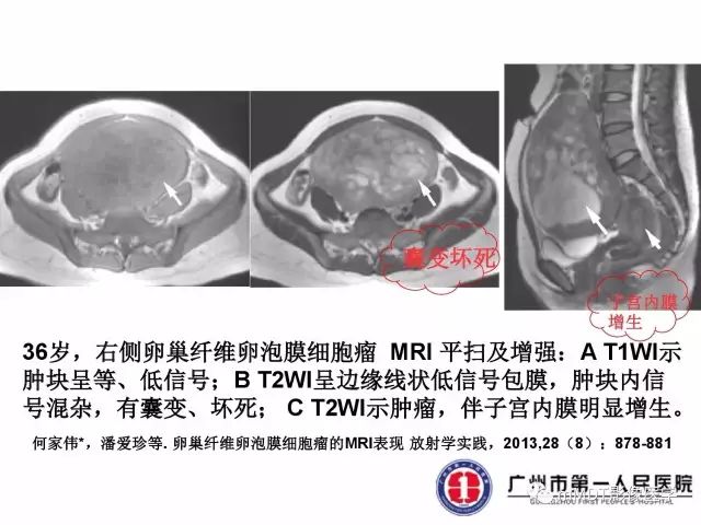 【病例】卵巢硬化性间质瘤1例MR