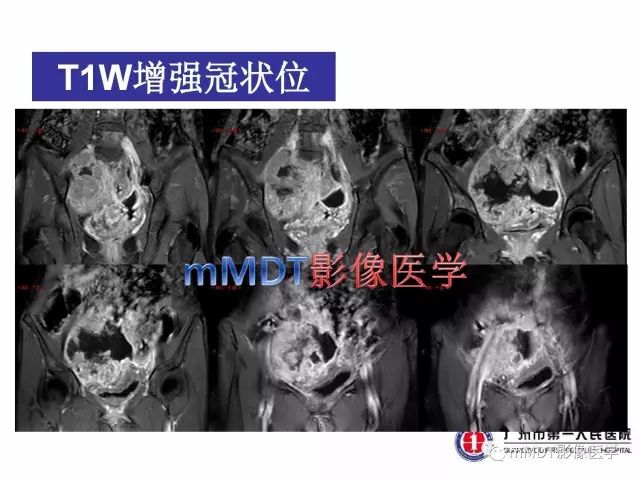 【病例】卵巢PNET1例CT及MR