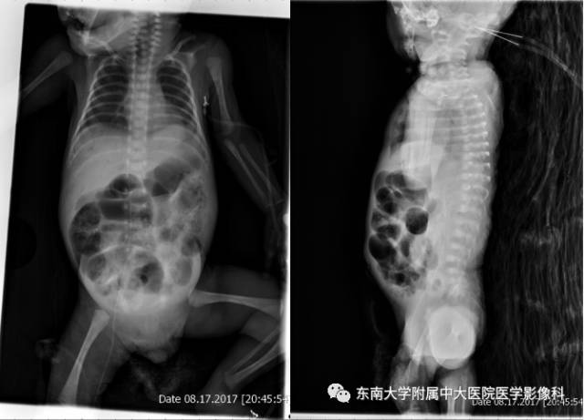 【病例】新生儿坏死性肠炎1例X线CT影像表现 【病例】新生儿坏死性肠炎1例X线CT影像表现
