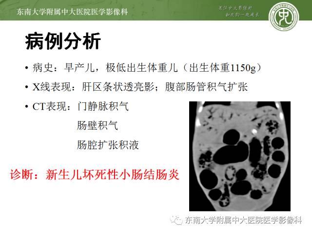 【病例】新生儿坏死性肠炎1例X线CT影像表现 【病例】新生儿坏死性肠炎1例X线CT影像表现