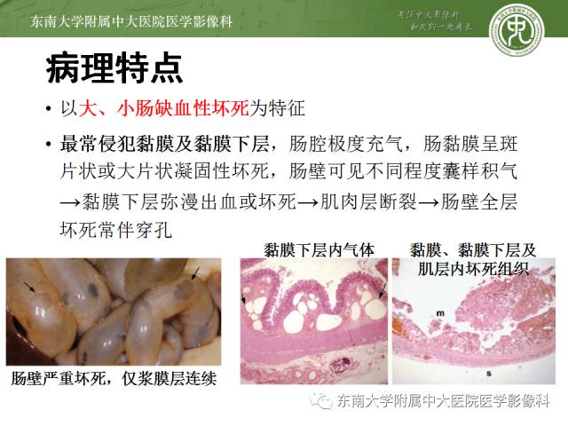 【病例】新生儿坏死性肠炎1例X线CT影像表现 【病例】新生儿坏死性肠炎1例X线CT影像表现