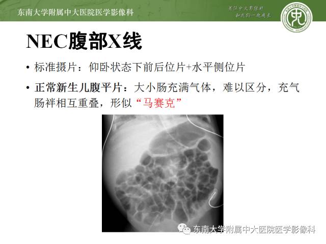 【病例】新生儿坏死性肠炎1例X线CT影像表现 【病例】新生儿坏死性肠炎1例X线CT影像表现