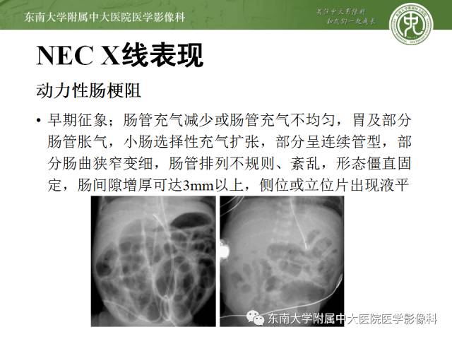 【病例】新生儿坏死性肠炎1例X线CT影像表现 【病例】新生儿坏死性肠炎1例X线CT影像表现