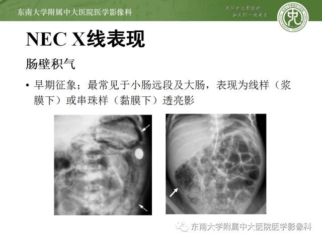 【病例】新生儿坏死性肠炎1例X线CT影像表现 【病例】新生儿坏死性肠炎1例X线CT影像表现