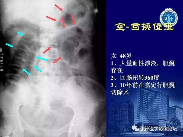 【PPT】急性绞窄性肠梗阻CT诊断