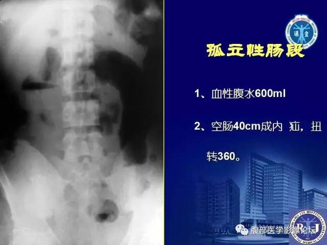 【PPT】急性绞窄性肠梗阻CT诊断