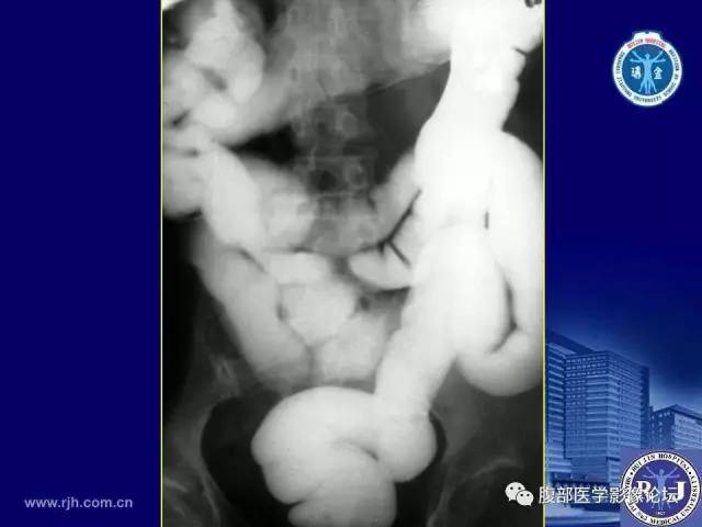 【PPT】急性绞窄性肠梗阻CT诊断