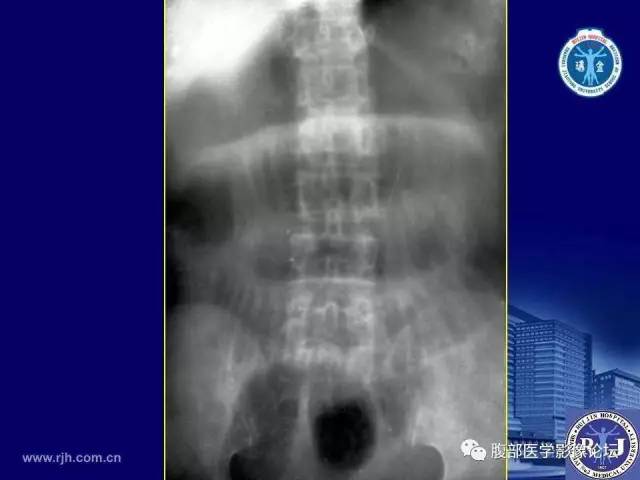 【PPT】急性绞窄性肠梗阻CT诊断