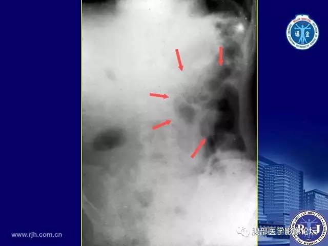 【PPT】急性绞窄性肠梗阻CT诊断
