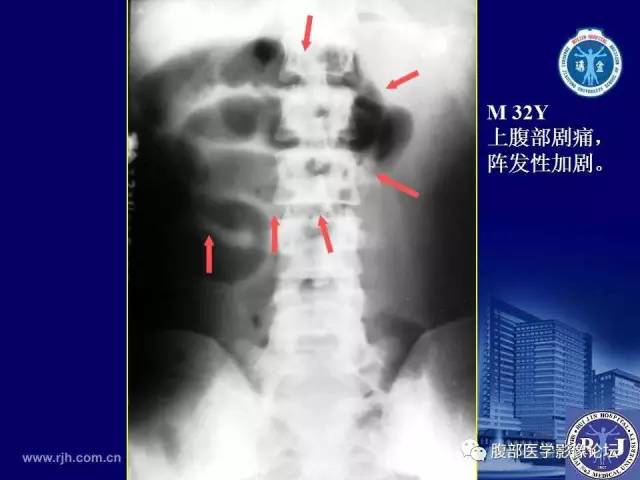 【PPT】急性绞窄性肠梗阻CT诊断