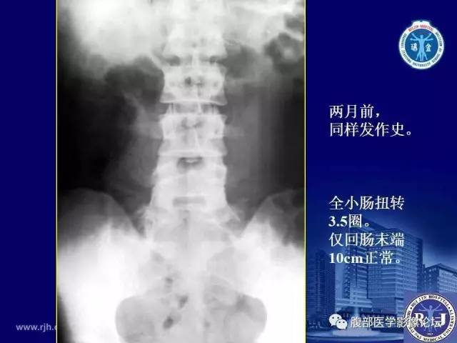 【PPT】急性绞窄性肠梗阻CT诊断