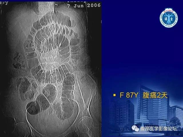 【PPT】急性绞窄性肠梗阻CT诊断