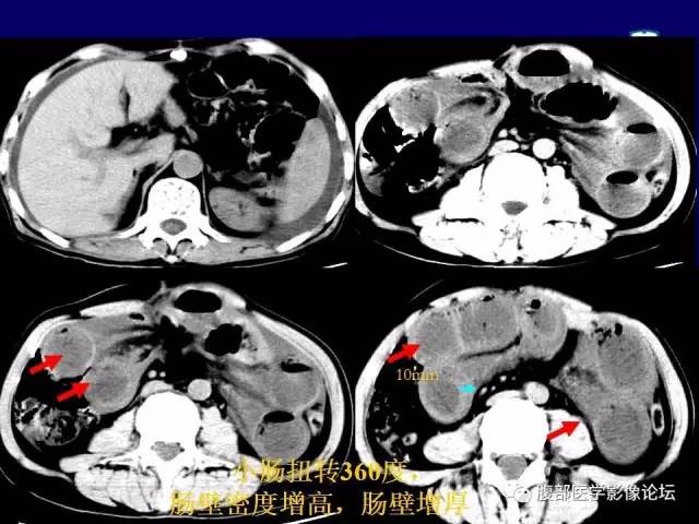 【PPT】急性绞窄性肠梗阻CT诊断