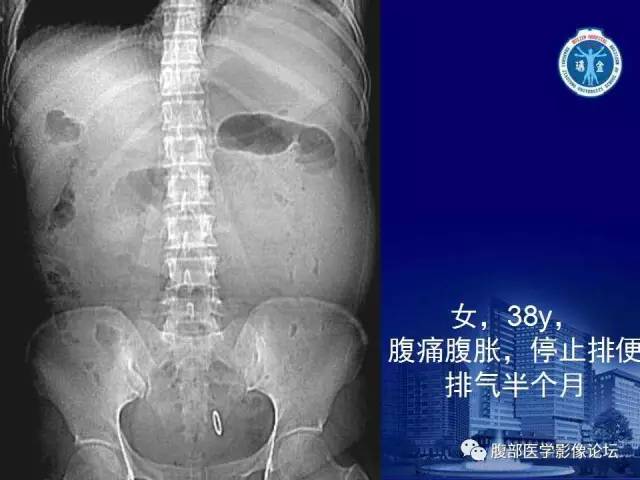【PPT】急性绞窄性肠梗阻CT诊断