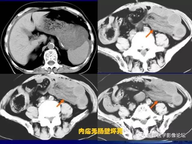 【PPT】急性绞窄性肠梗阻CT诊断