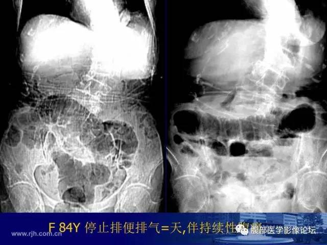 【PPT】急性绞窄性肠梗阻CT诊断