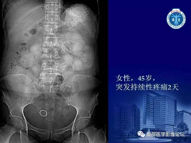 【PPT】急性绞窄性肠梗阻CT诊断