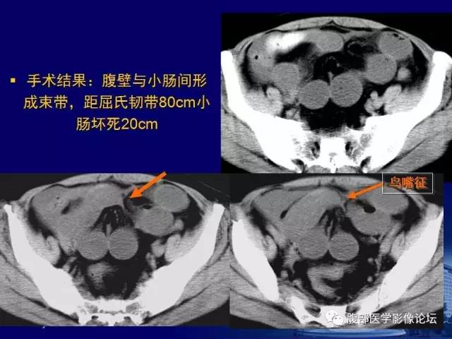 【PPT】急性绞窄性肠梗阻CT诊断