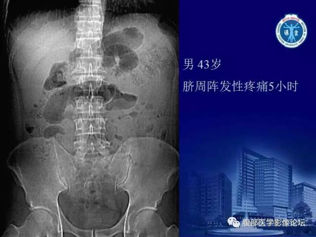【PPT】急性绞窄性肠梗阻CT诊断