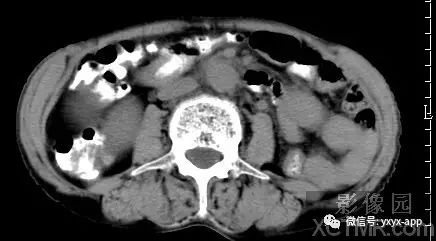 【病例】阑尾粘液囊肿1例CT影像诊断