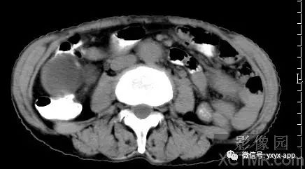 【病例】阑尾粘液囊肿1例CT影像诊断