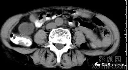 【病例】阑尾粘液囊肿1例CT影像诊断