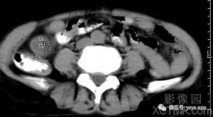【病例】阑尾粘液囊肿1例CT影像诊断