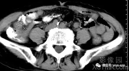【病例】阑尾粘液囊肿1例CT影像诊断