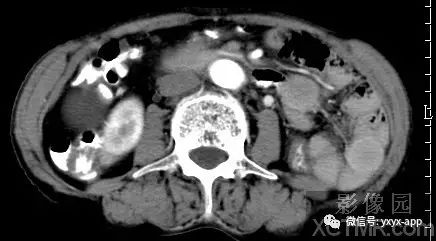 【病例】阑尾粘液囊肿1例CT影像诊断