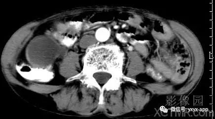 【病例】阑尾粘液囊肿1例CT影像诊断