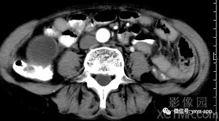 【病例】阑尾粘液囊肿1例CT影像诊断