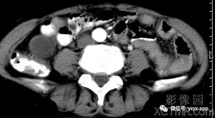 【病例】阑尾粘液囊肿1例CT影像诊断