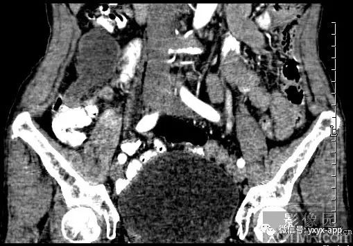 【病例】阑尾粘液囊肿1例CT影像诊断