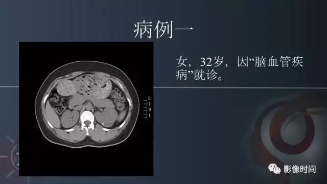 【PPT】肾脏高密度螺旋 CT 诊断思路