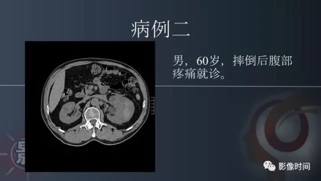 【PPT】肾脏高密度螺旋 CT 诊断思路