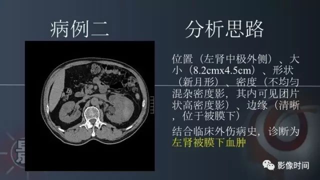 【PPT】肾脏高密度螺旋 CT 诊断思路