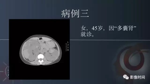 【PPT】肾脏高密度螺旋 CT 诊断思路
