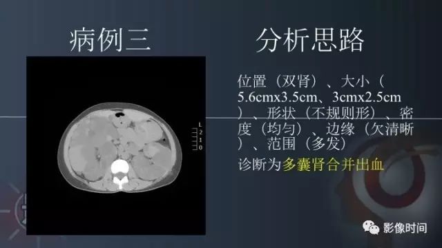 【PPT】肾脏高密度螺旋 CT 诊断思路
