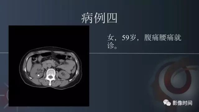 【PPT】肾脏高密度螺旋 CT 诊断思路