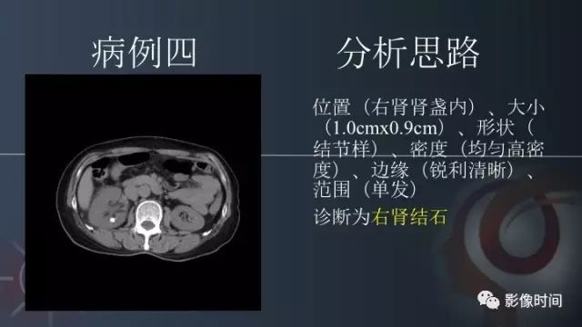 【PPT】肾脏高密度螺旋 CT 诊断思路