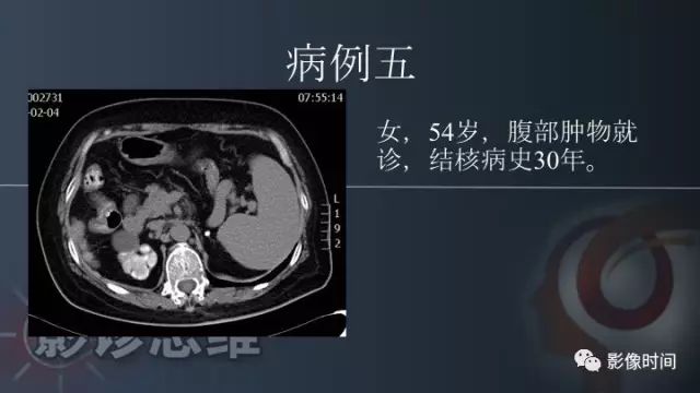 【PPT】肾脏高密度螺旋 CT 诊断思路