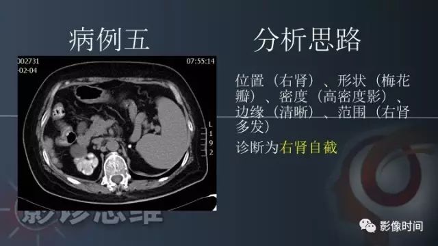 【PPT】肾脏高密度螺旋 CT 诊断思路