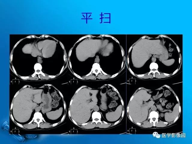 【病例】胆囊癌1例CT影像表现