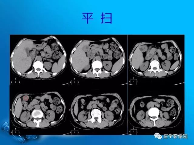 【病例】胆囊癌1例CT影像表现
